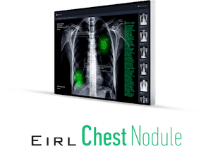 EIRL Chest Nodule
