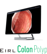 EIRL Colon Polyp